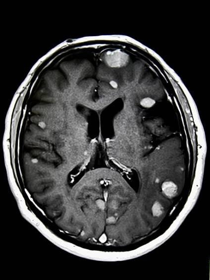 Stereotactic RT Cuts Neurologic Deaths in SCLC, Brain Mets
