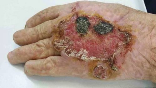 Kožní příznaky keratoakantomu v počáteční fázi, diagnostika a léčba / Beníné novotvary | Užitečné informace a tipy na péči