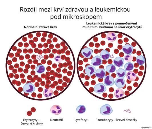 Rozdíl mezi leukémií akutní a chronickou