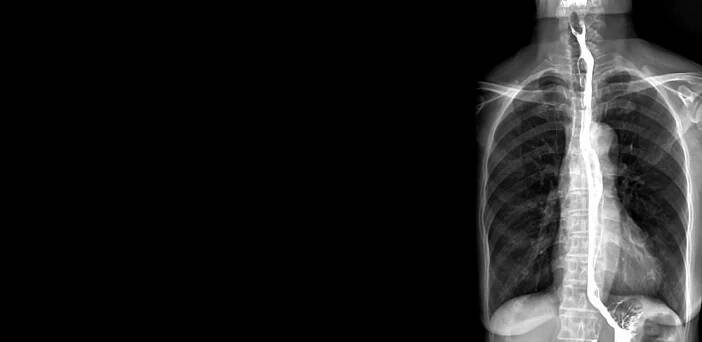 K odhalení rakoviny jícnu slouží fyzikální vyšetření, laboratorní vyšetření krve, rentgen jícnu, endoskopie s biopsií, endosonografie a CT hrudníku. Zdroj: Shutterstock.com