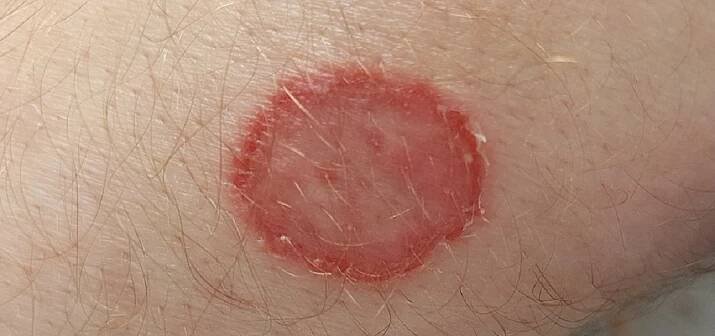 fungal infection skin ringworm