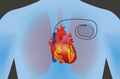 What is pacemaker implant?