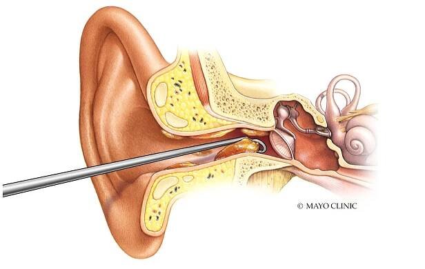 Earwax removal by a healthcare professional