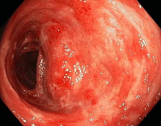 Quadro endoscopico di retto-colite ulcerativa 