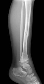 Zlomená noha rentgeny obrázek ukazující desku a šroub fixace holenní a lýtkové kosti — Stock obrázek