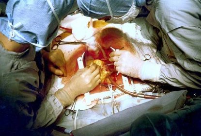 Soubor:Coronary artery bypass surgery Image 657B-PH.jpg – WikiSkripta