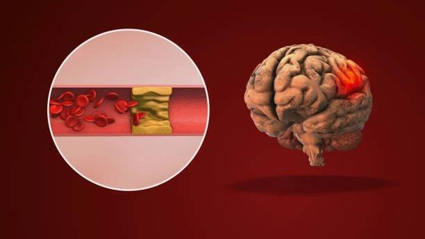 periferní neuropatie může způsobit bolest - neuropatie - stock snímky, obrázky a fotky