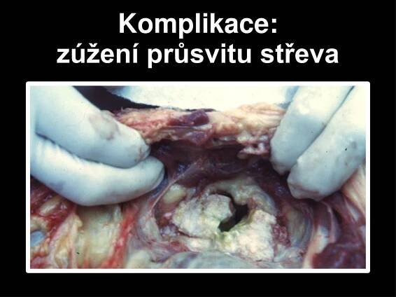 PPT - Kolorektální karcinom PowerPoint Presentation, free download - ID:5290455