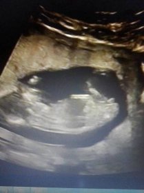 Je to holčička nebo chlapeček? Foto ultrazvuku - str. 18 - Modrý koník