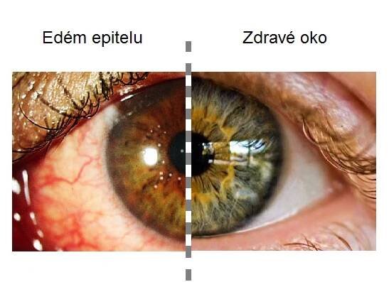 rohovkový edém