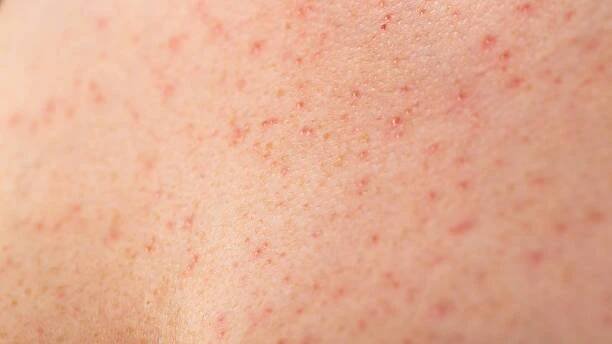 červené pupínky a vyrážky na ženské kůži. koncepce chronických dermatologických onemocnění, alergie na léky, ekzém - spála - stock snímky, obrázky a fotky
