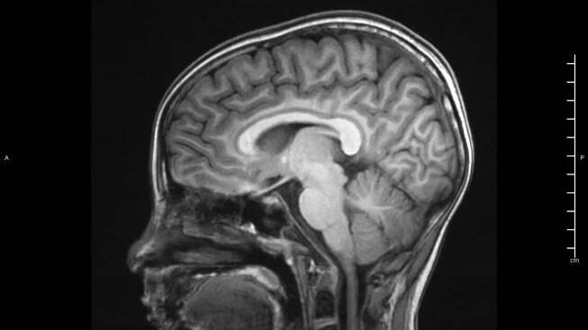 AI May Aid in Diagnosing Teens With ADHD