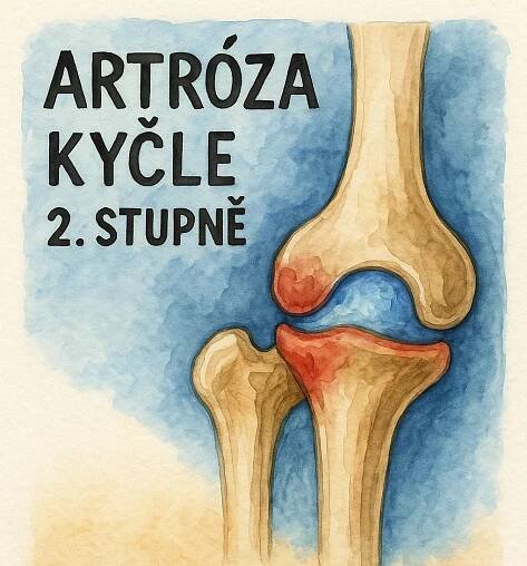 Artróza kyčle 2. stupně