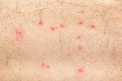 Detail komár přímých alergii na zralý muž kůži — Stock obrázek