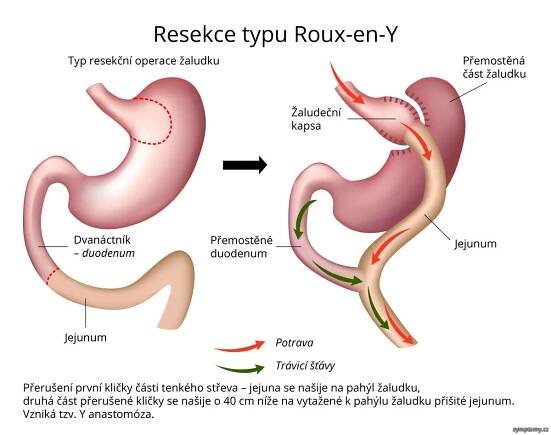 Gastrický bypass ROUX-en-Y spojka - příznaky a léčba