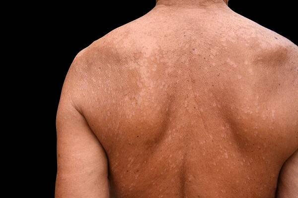 Je estetickým problémom, no nie je nijako nebezpečná – prečítajte si o pityriasis versicolor | lekar.sk