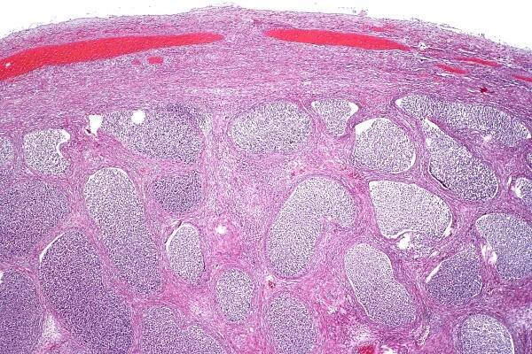 Epididymitis