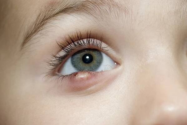 Child with stye