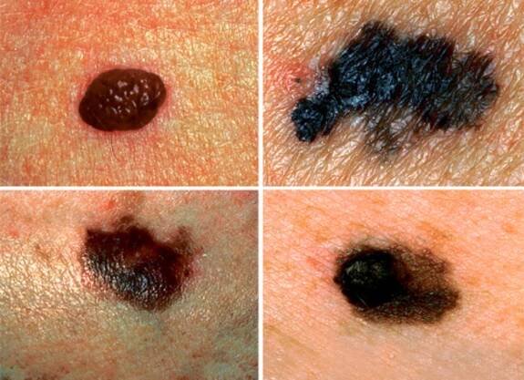 how to get rid of moles