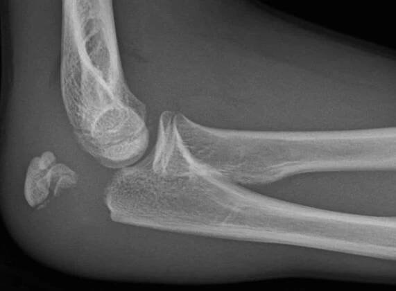 Olecranon Fractures - Pathophysiology - Management - TeachMeSurgery