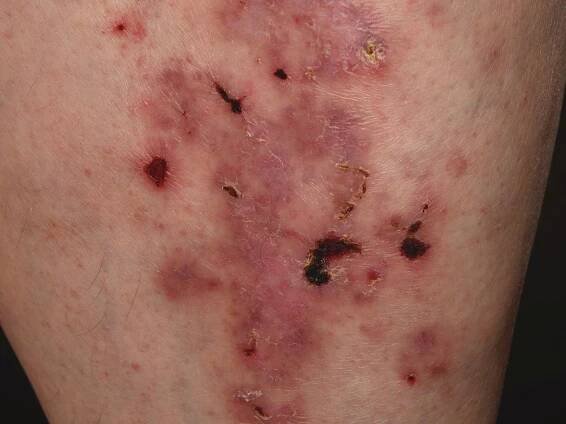 Lichen planus atrophicans