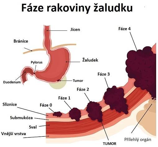Fáze rakoviny žaludku