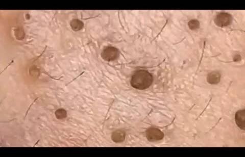 Blackheads & Whiteheads Satisfying Removal @0116