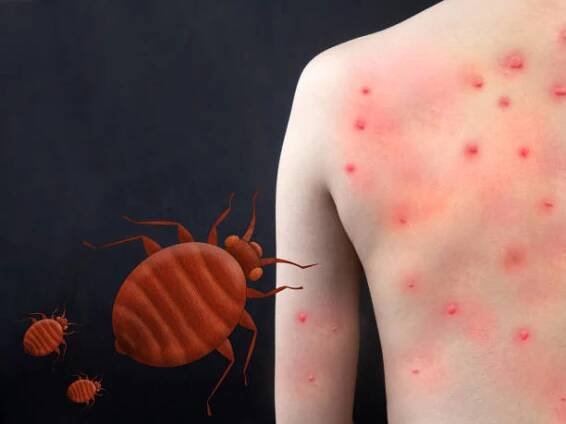 bedbug kousnutí na lidské tělo. svědivé, červené skvrny na kůži způsobené kousnutím hmyzem. cimex lectularius je druh domácího hmyzu sání krve. - štěnice domácí - stock snímky, obrázky a fotky