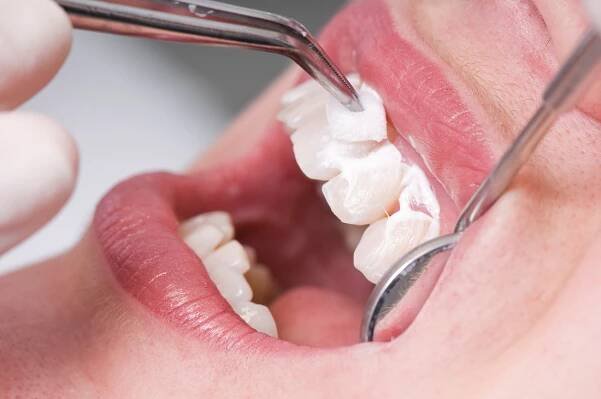 Vorbereitung für das Bleaching