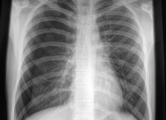 Pneumotorax - RTG | Medicína, nemoci, studium na 1. LF UK