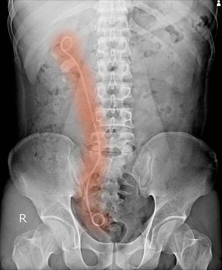 Břicha X-ray ukazuje double J stent zmírnit colics z ledvin stone.too měkké, když pohledy plné solusion.medical obrázek. — Stock obrázek