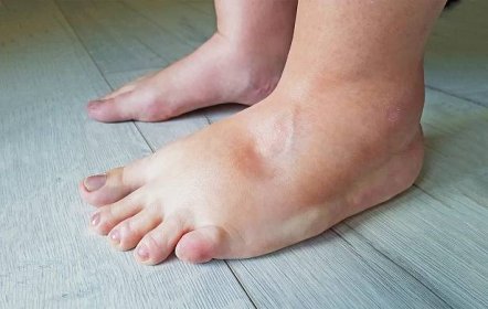 Otoky nohou mají různé příčiny a pro vysoké teploty je typický edém z horka