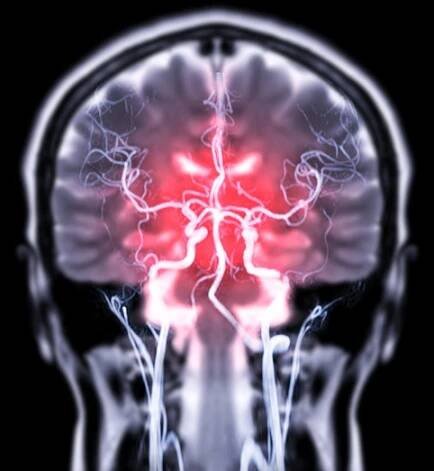 Posttraumatická epilepsie může mít velmi různý průběh. U některých lidí lze záchvaty kontrolovat pomocí léků, zatímco jiní mohou trpět častými a závažnými záchvaty, které výrazně ovlivňují kvalitu jejich života.