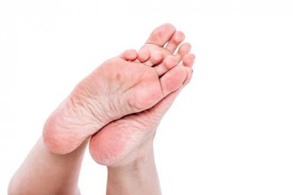 Ženské nohy s overdried sušené suché kůže na paty closeup — Stock fotografie