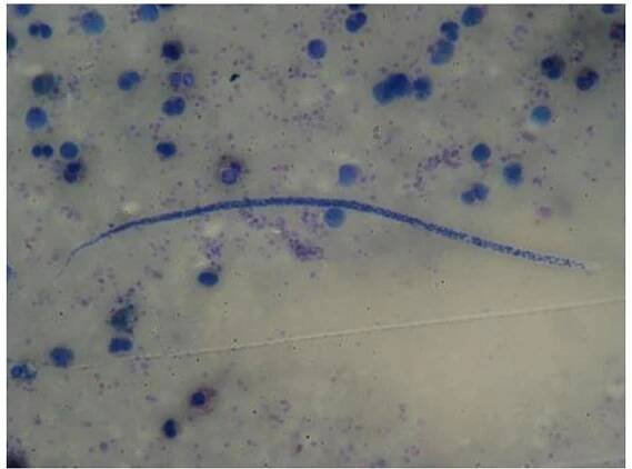 Figure 4: Microfilaria in FNAC of gluteal mass.  Filariasis affecting genitourinary region is common as seen in study of A Manoharan.° But in our study we have found 3 cases presenting as soft tissue swelling and 2 cases in lymphnode. Filariasis often occurs in endemic areas, especially in tropical countries around the world. The agriculture sector is mainly found in lowland and swampy areas surrounded by forests, agricultural areas, beaches, plantations and rehabilitant areas. Two species of worms most often associated with this disease are wucheria bancrofti and Brugia malayi. The larval form of parasite transmits the disease by the bite of tiger mosquito. Detection of filarial parasite in blood smear and Buffy coat is relatively easy but detection of parasite in tissue section i.e. lymph node, lung, soft tissue swelling etc. require cautious eye where microfilaria or larval form or both can be seen (Figure 4). ? Finding of E. Vermicular is being most common parasite found in appendix specimen (Figure 4) operated for acute appendicitis matches with the study of Aydin et al and Da Silva et al.!°!! Parasitic diseases caused by helminths, or worms, account for billions of human _ infections worldwide. Notably, many helminthic diseases present with specific and nonspecific signs and symptoms like abdominal pain, chronic diarrhea, anemia, cough, allergy, dermatologic signs and symptoms including skin nodules, cysts, migratory skin lesions, and pruritus etc.*>  