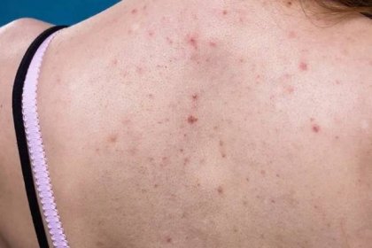Zdravotní problém, kožní onemocnění. Mladá žena ukazuje záda s alergickou vyrážkou akné — Stock obrázek