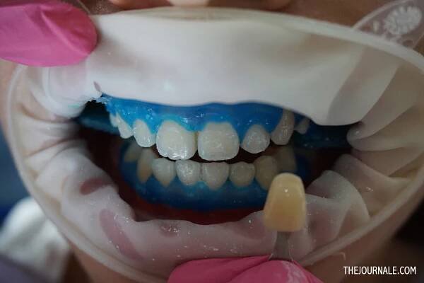 Review 30 Minutes Bleaching: Senyum Lebih Cantik dalam Waktu Singkat!