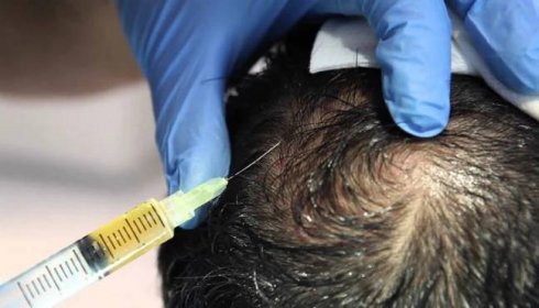 Mezoterapie vlasů - léčba vypadávání vlasů mezoterapií