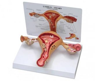 Model ženské dělohy s onemocněním
