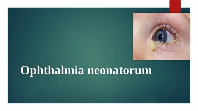 Ophthalmia neonatorum
 