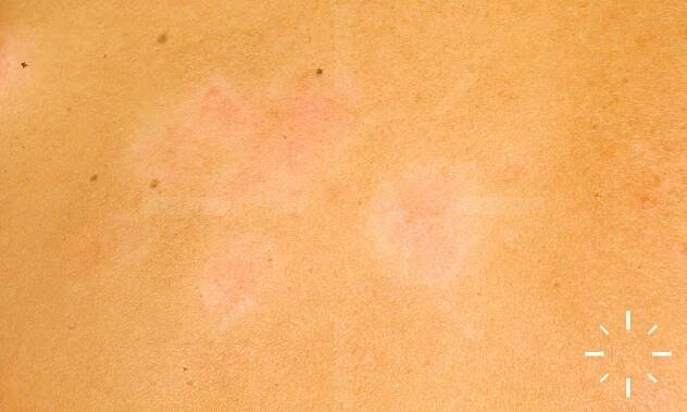 DermaCompass - Psoriasis vulgaris 