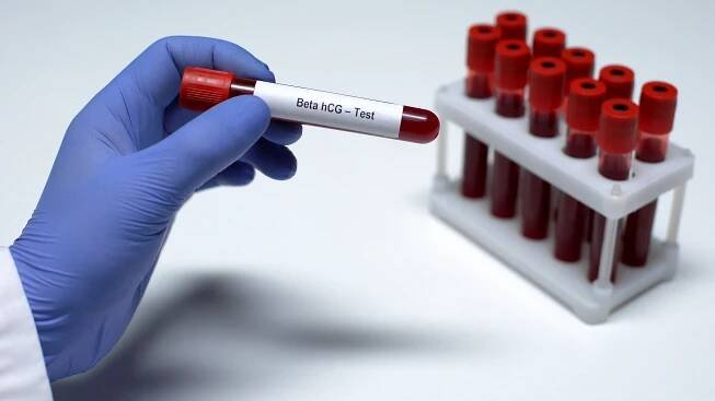 beta hcg test, lékař ukazující vzorek krve v tubě, laboratorní výzkum, zdravotní prohlídky - inseminace - stock snímky, obrázky a fotky
