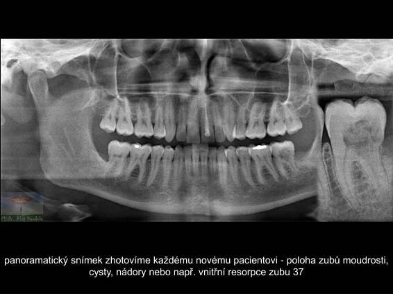 PPT - KOMPLETNÍ REKONSTRUKCE DEVITÁLNÍHO ZUBU PowerPoint Presentation - ID:4981747