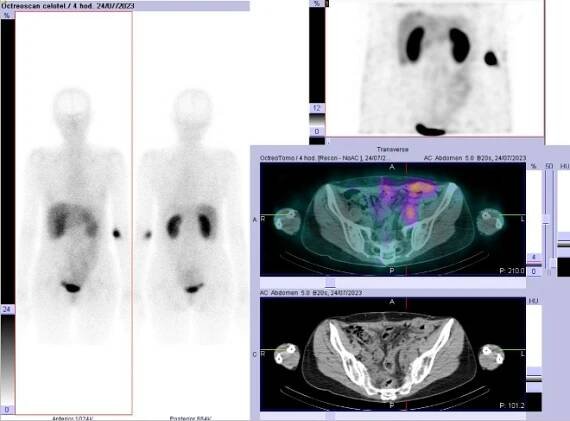 Obr. č. 1: Celotělová scintigrafie v přední a zadní projekci a SPECT/CT břicha a pánve 4 hod. po aplikaci OctreoScanu.