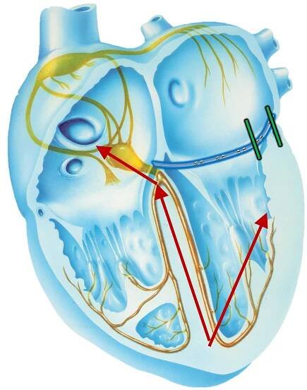 Electrogram Interpretation - 23 - EP Essentials