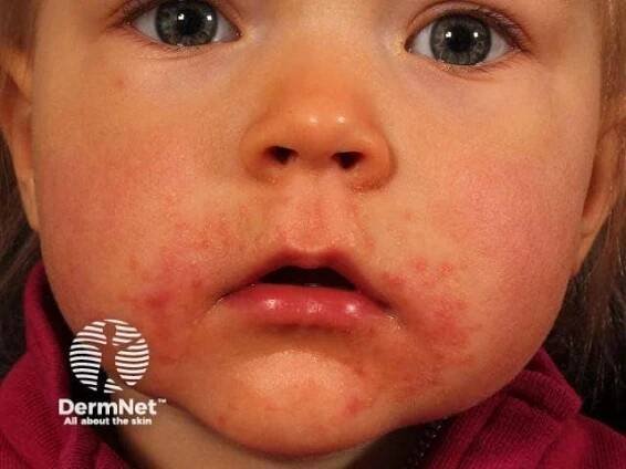 Trápí vás periorální dermatitida? Jak ji poznat, proč vzniká a jak se jí zbavit | Vitalpoint lékárna