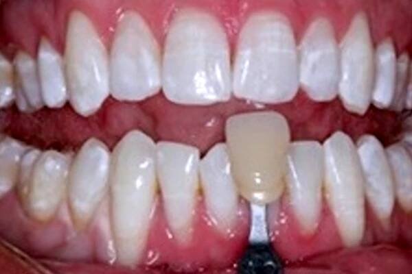 Seeing is Believing - Amazing KöR Whitening Results