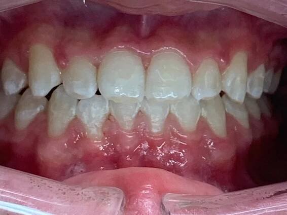 Invisalign Under Bite After