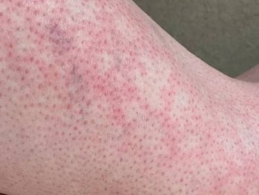 Kopřivka alergická reakce na koleno close-up referenční obrázek skvrnité skvrnité červené kůže erytém ab igne také známý jako EAI — Stock obrázek