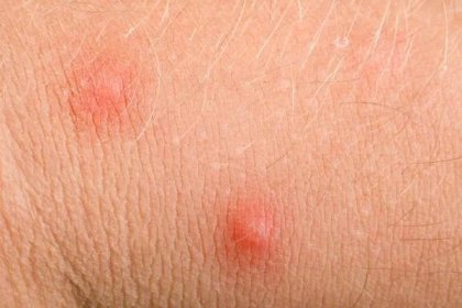 Makro pupínky alergie na mužské pokožky rukou — Stock obrázek